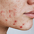 Acne Scar Treatment